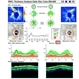 Bilateral Optic Nerve Pits - ON OCTs